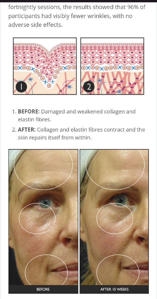 silk'n gently used anti aging laser image indicator(7)