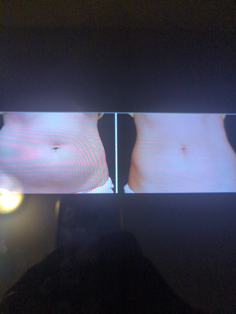 Fat Freezing Machine - photo 4